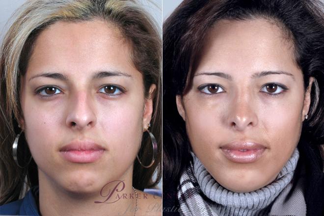 Rhinoplasty Case 155 Before & After View #1 | Paramus, NJ | Parker Center for Plastic Surgery