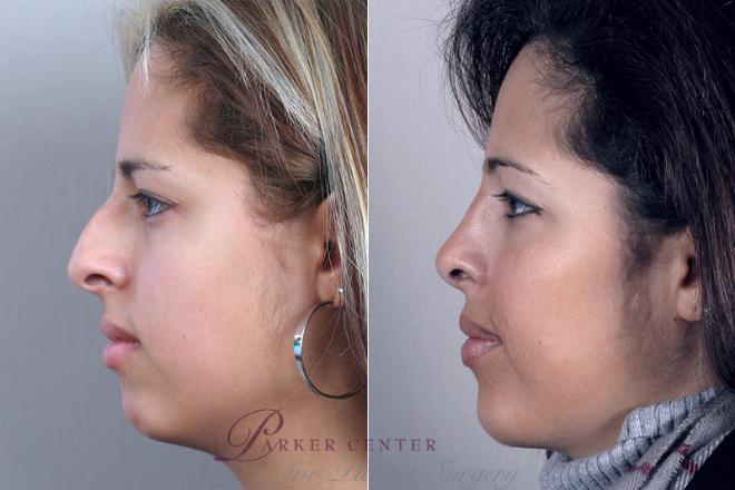 Rhinoplasty Case 155 Before & After View #2 | Paramus, NJ | Parker Center for Plastic Surgery
