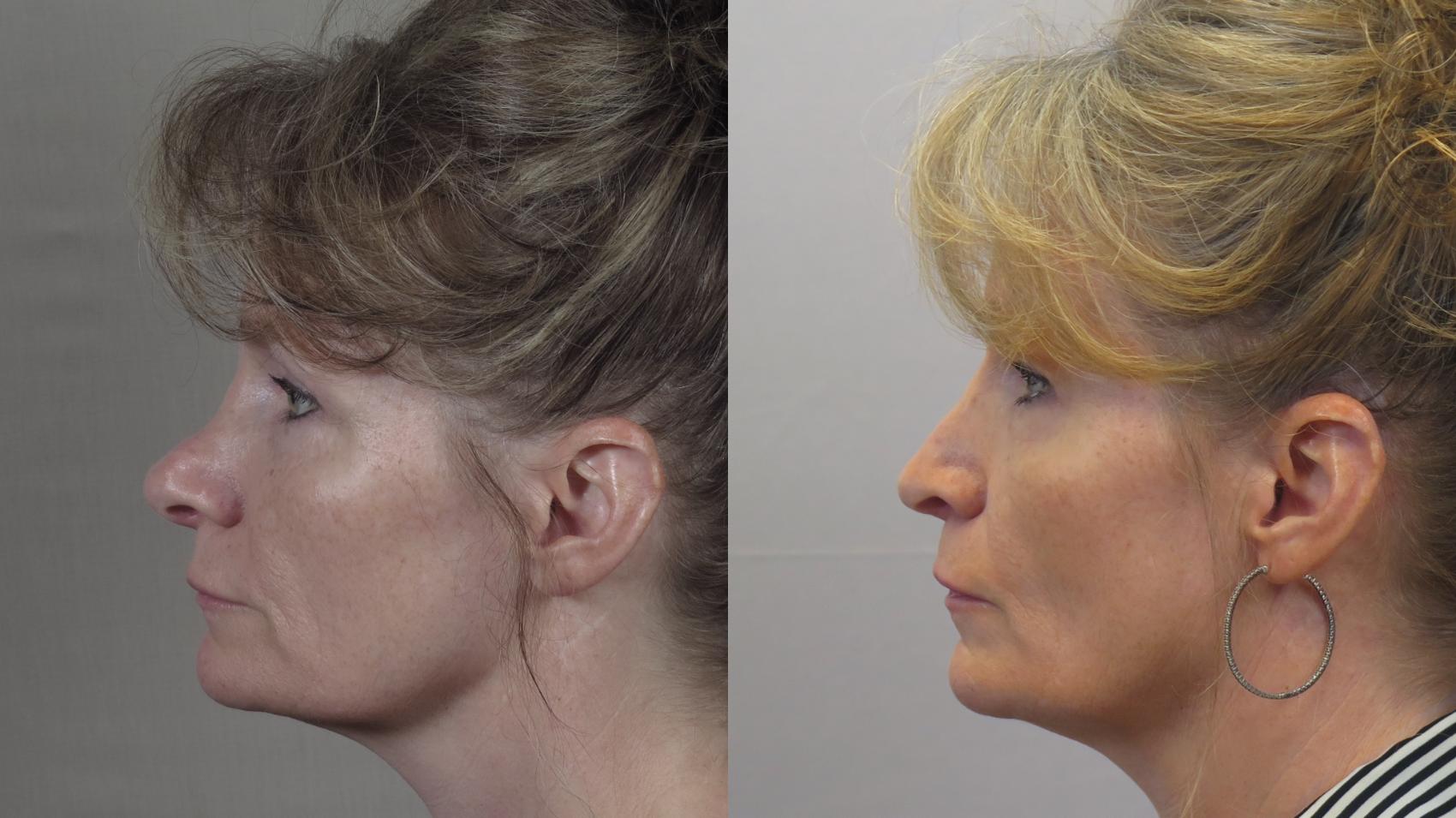 Rhinoplasty Case 1562 Before & After Left Side | Paramus, New Jersey | Parker Center for Plastic Surgery