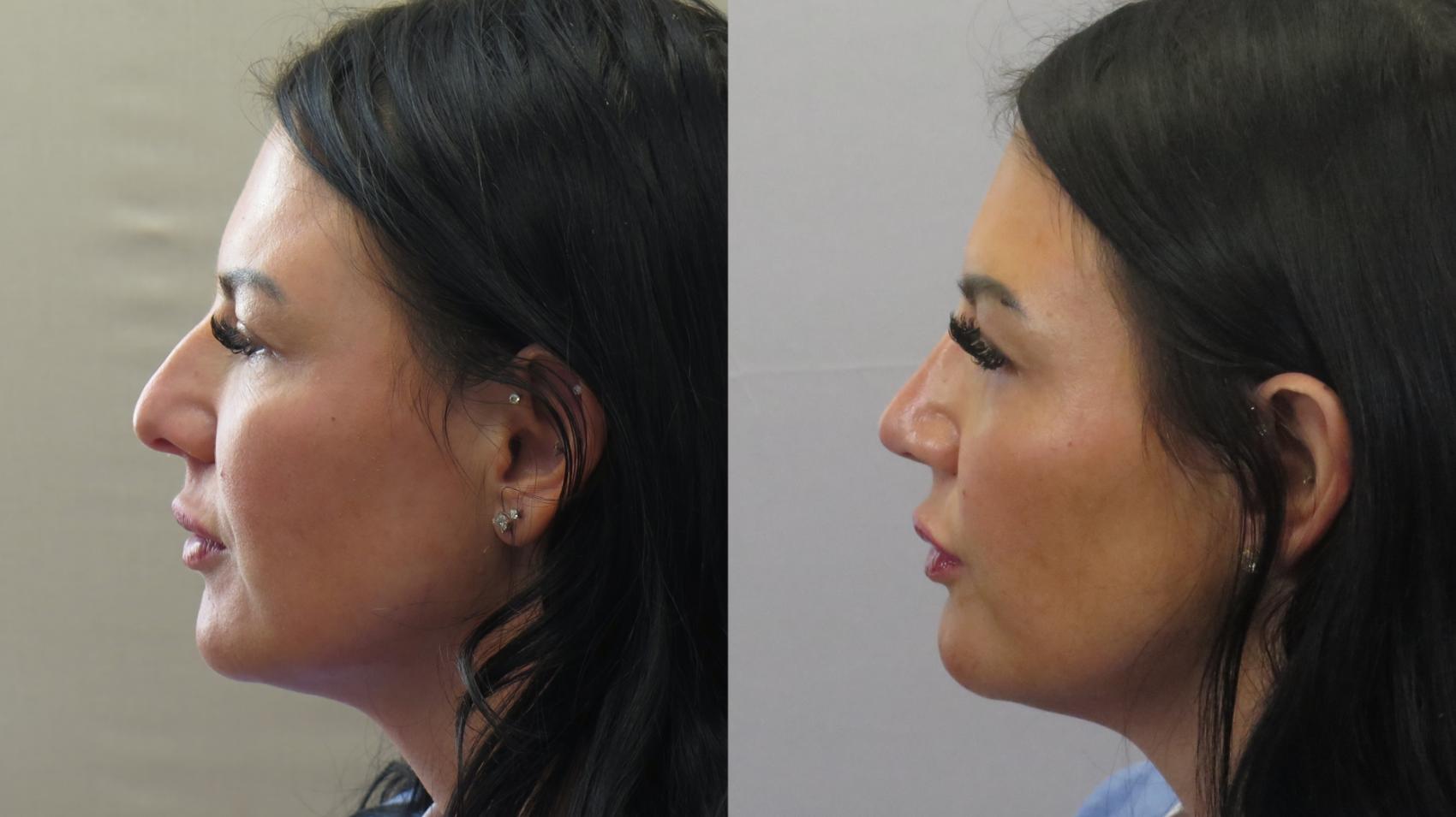 Rhinoplasty Case 1587 Before & After Left Side | Paramus, New Jersey | Parker Center for Plastic Surgery
