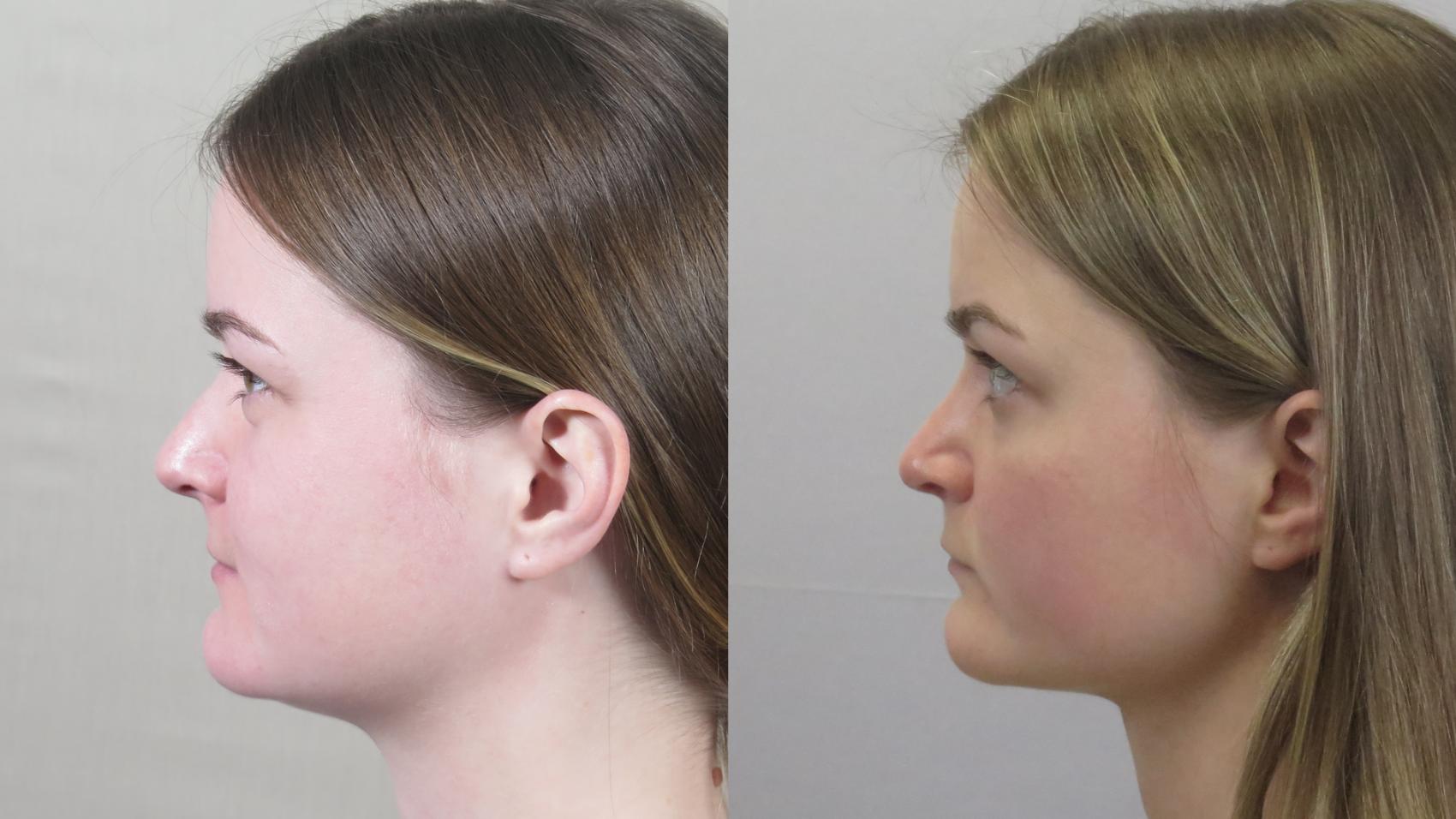 Rhinoplasty Case 1590 Before & After Left Side | Paramus, New Jersey | Parker Center for Plastic Surgery