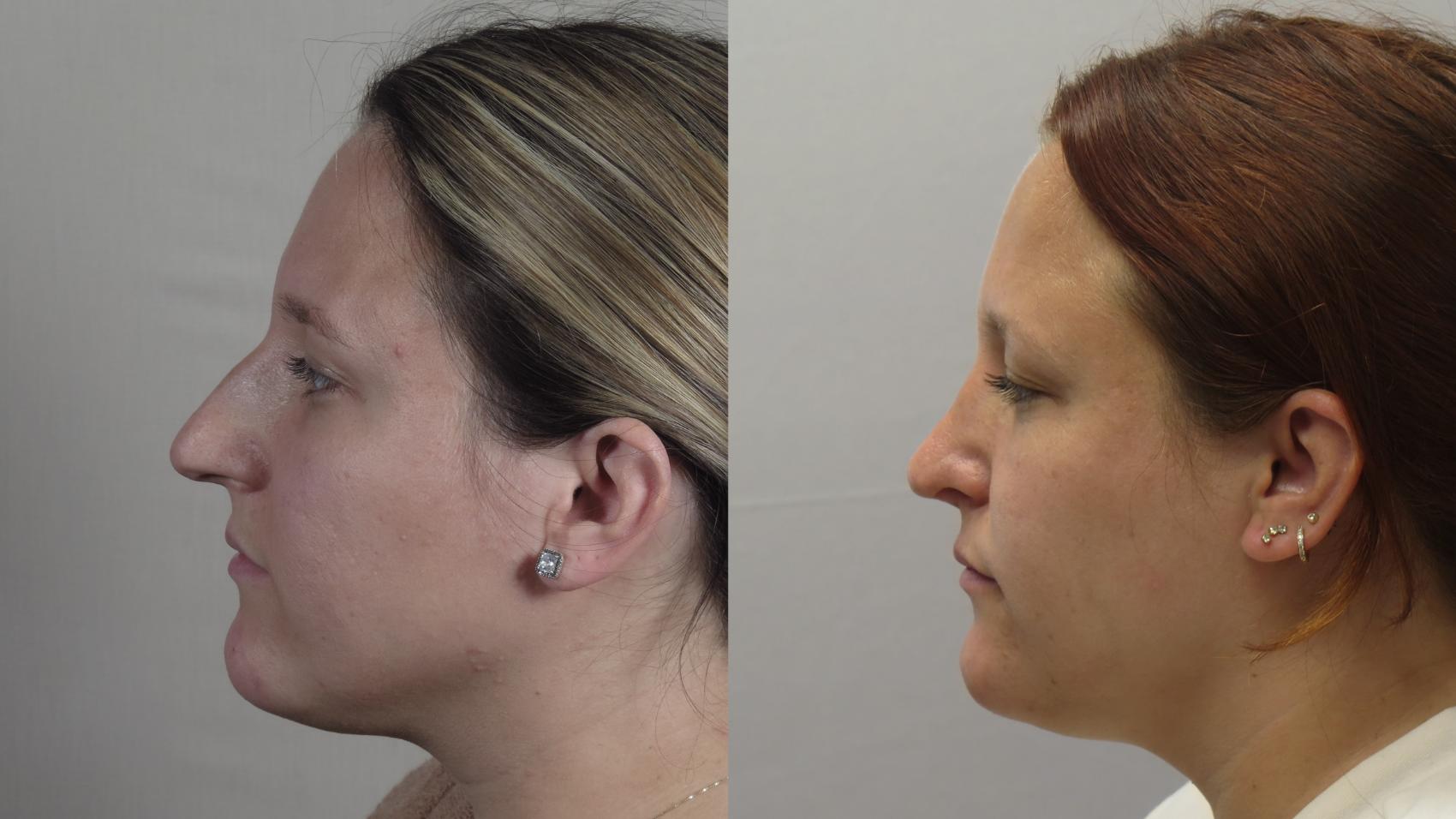 Rhinoplasty Case 1611 Before & After Left Side | Paramus, New Jersey | Parker Center for Plastic Surgery