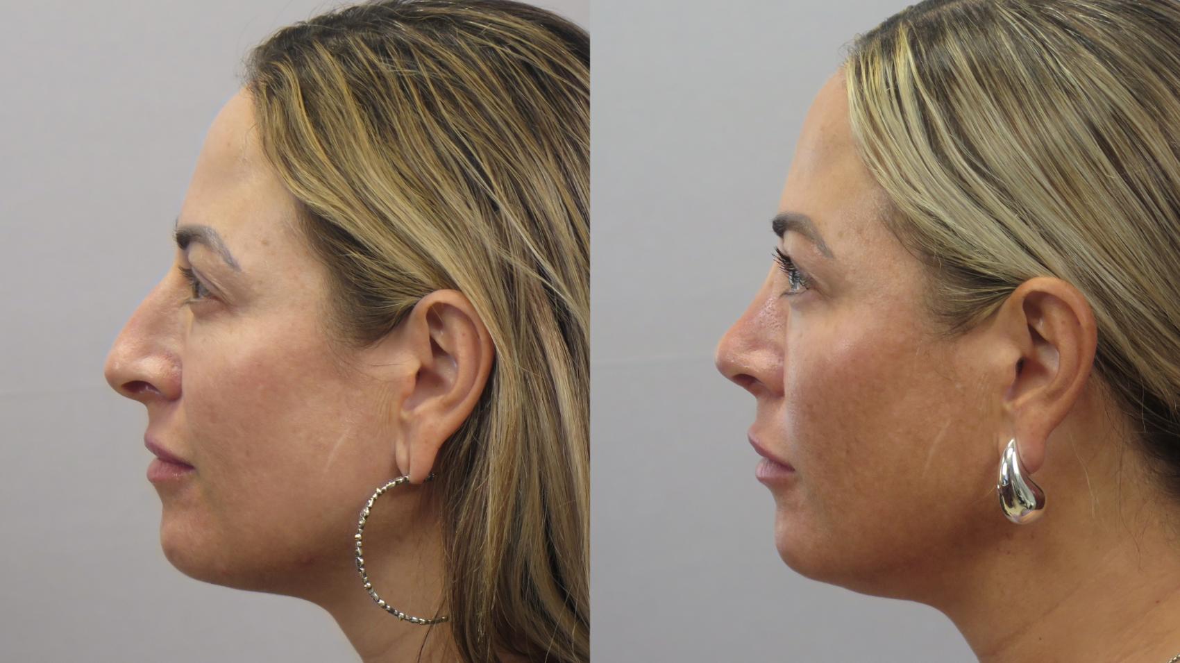 Rhinoplasty Case 1622 Before & After Left Side | Paramus, New Jersey | Parker Center for Plastic Surgery