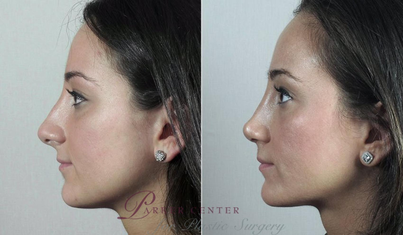 Rhinoplasty Case 191 Before & After View #2 | Paramus, NJ | Parker Center for Plastic Surgery