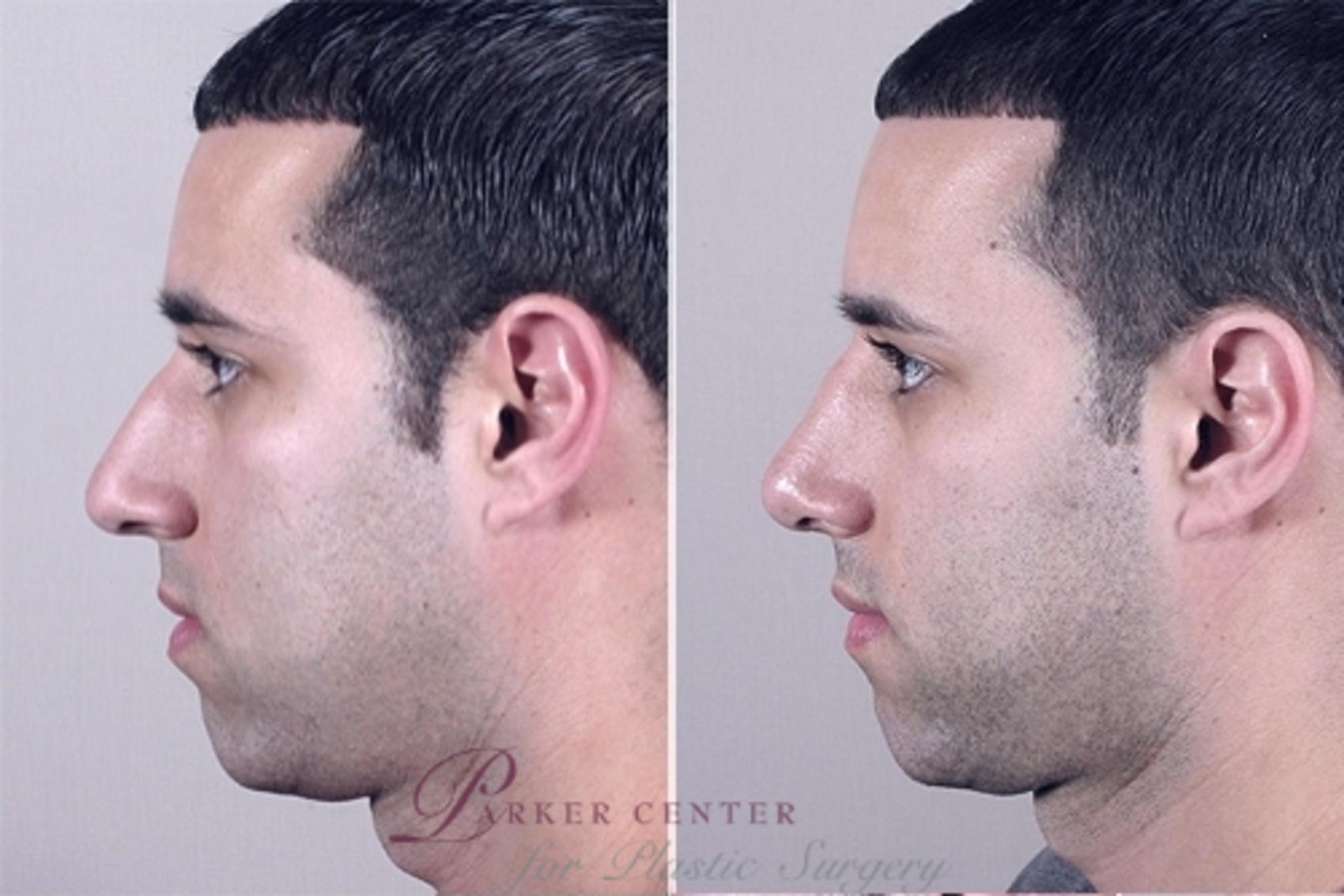 Rhinoplasty Case 952 Before & After View #5 | Paramus, NJ | Parker Center for Plastic Surgery