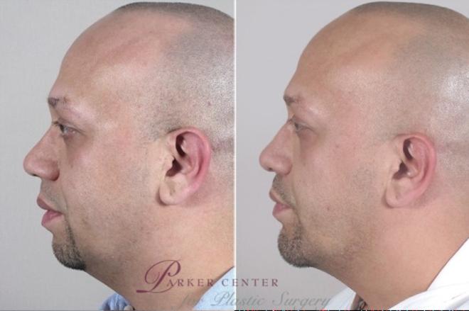 Rhinoplasty Case 953 Before & After View #5 | Paramus, NJ | Parker Center for Plastic Surgery