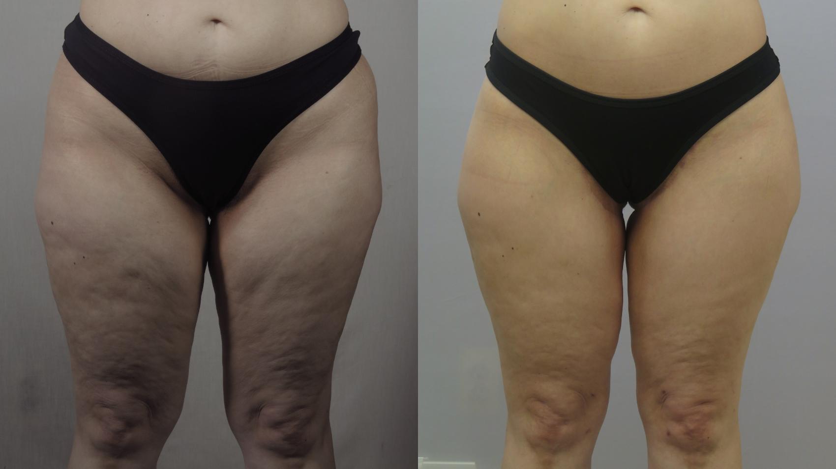 Thigh Lift Case 1605 Before & After Front | Paramus, New Jersey | Parker Center for Plastic Surgery