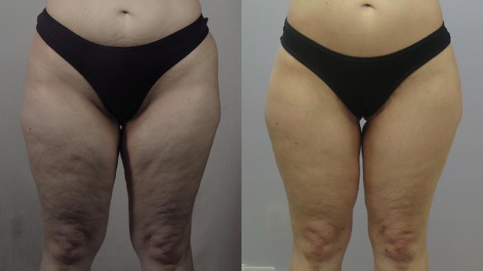 Thigh Lift Case 1605 Before & After Front | Paramus, New Jersey | Parker Center for Plastic Surgery