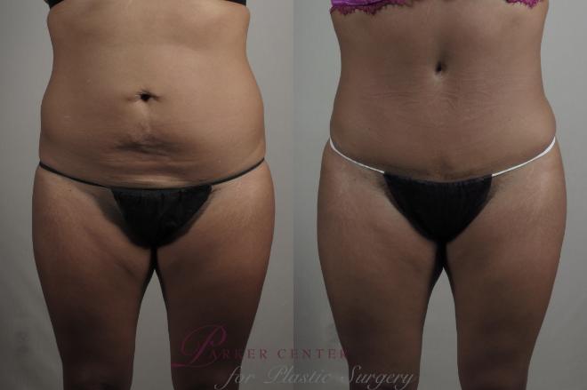 Tummy Tuck Case 1014 Before & After Front | Paramus, NJ | Parker Center for Plastic Surgery