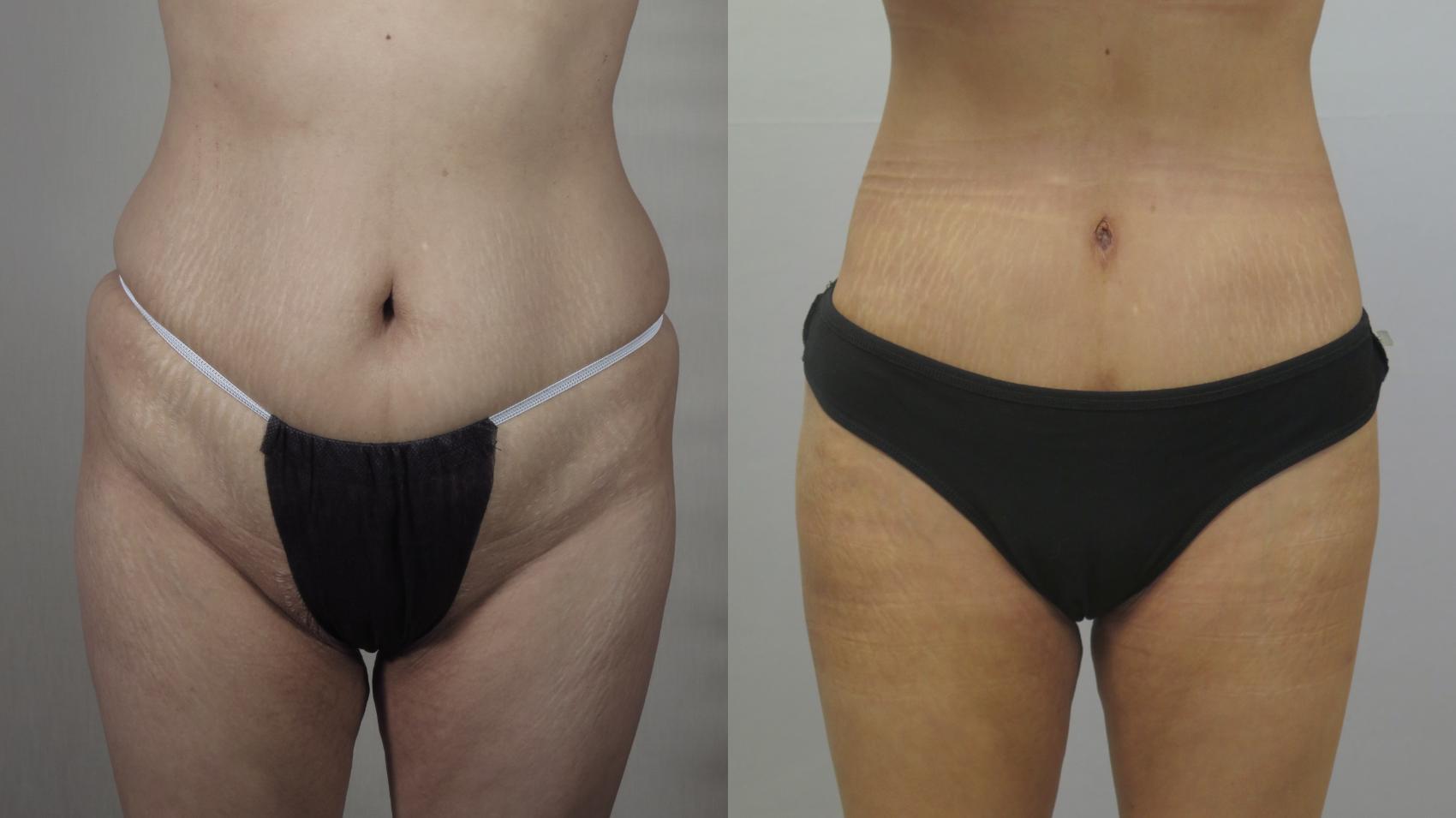 Tummy Tuck Case 1566 Before & After Front | Paramus, New Jersey | Parker Center for Plastic Surgery