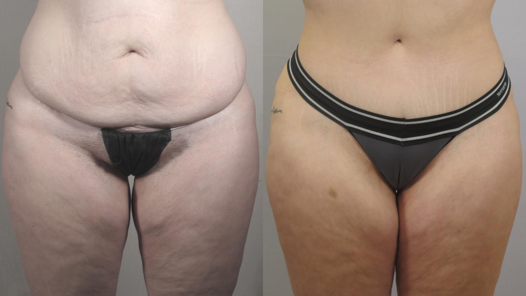 Tummy Tuck Case 1578 Before & After Front | Paramus, New Jersey | Parker Center for Plastic Surgery