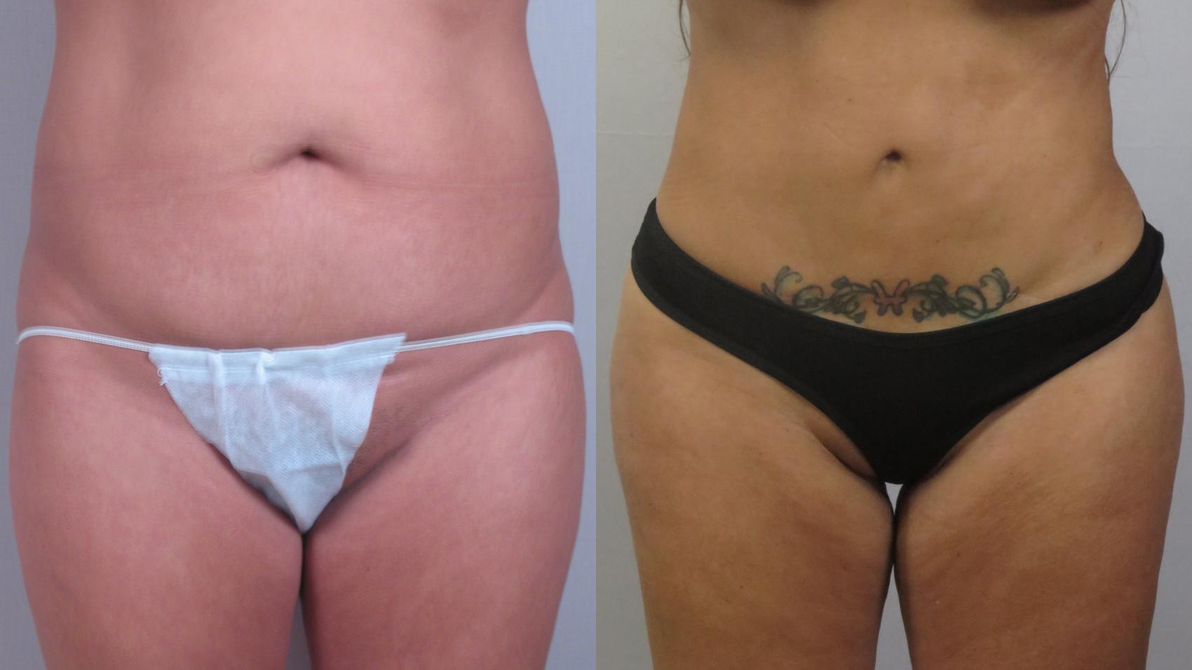 Tummy Tuck Case 1601 Before & After Front | Paramus, New Jersey | Parker Center for Plastic Surgery