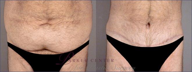 Tummy Tuck Case 682 Before & After View #1 | Paramus, NJ | Parker Center for Plastic Surgery