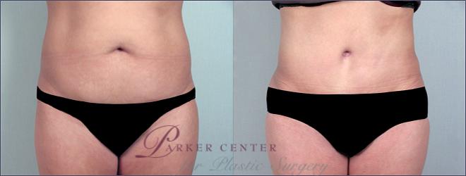 Tummy Tuck Case 691 Before & After View #1 | Paramus, NJ | Parker Center for Plastic Surgery