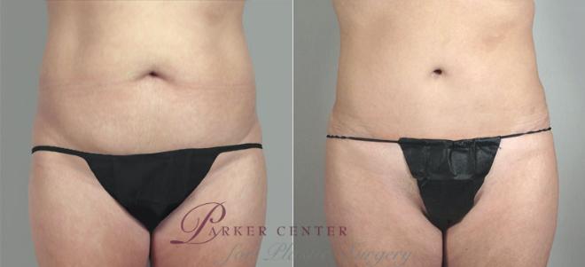 Tummy Tuck Case 717 Before & After View #1 | Paramus, NJ | Parker Center for Plastic Surgery