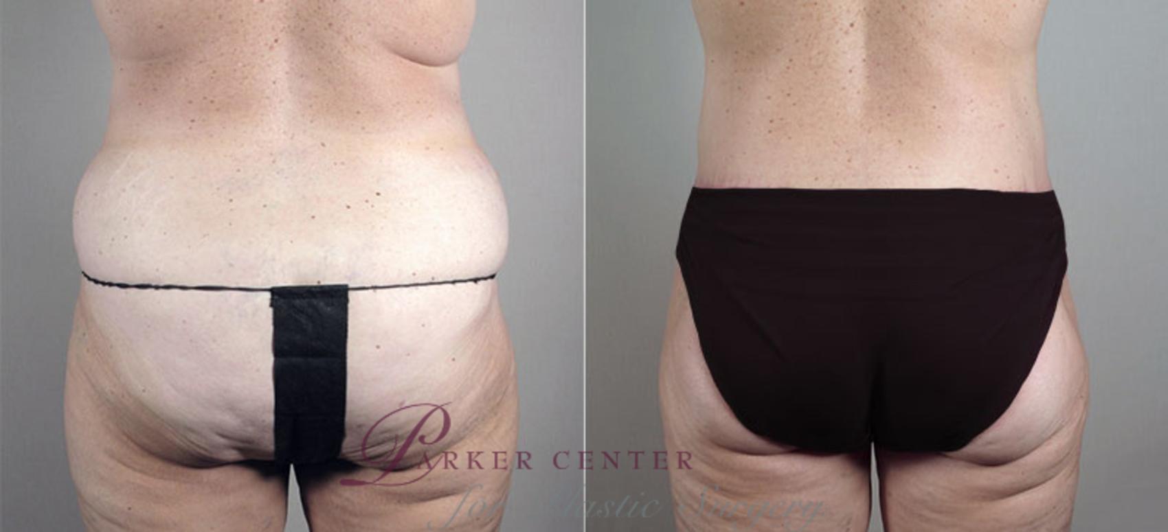 Thigh Lift Case 722 Before & After View #3 | Paramus, NJ | Parker Center for Plastic Surgery