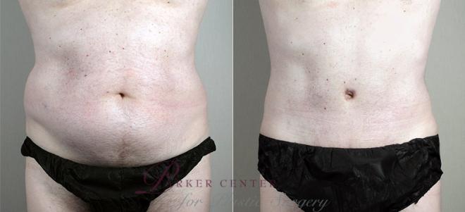 Tummy Tuck Case 725 Before & After View #1 | Paramus, NJ | Parker Center for Plastic Surgery