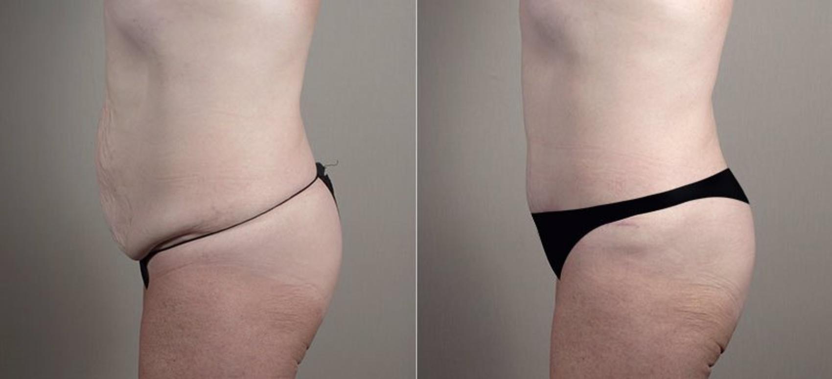 Tummy Tuck Case 734 Before & After View #1 | Paramus, NJ | Parker Center for Plastic Surgery