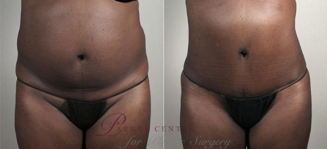 Tummy Tuck Case 735 Before & After View #1 | Paramus, NJ | Parker Center for Plastic Surgery