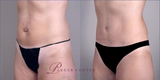 Tummy Tuck Case 911 Before & After View #5 | Paramus, NJ | Parker Center for Plastic Surgery