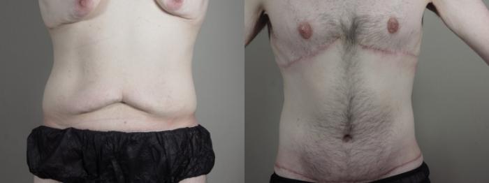 Abdominoplasty Case 1336 Before & After Front | Paramus, New Jersey | Parker Center for Plastic Surgery