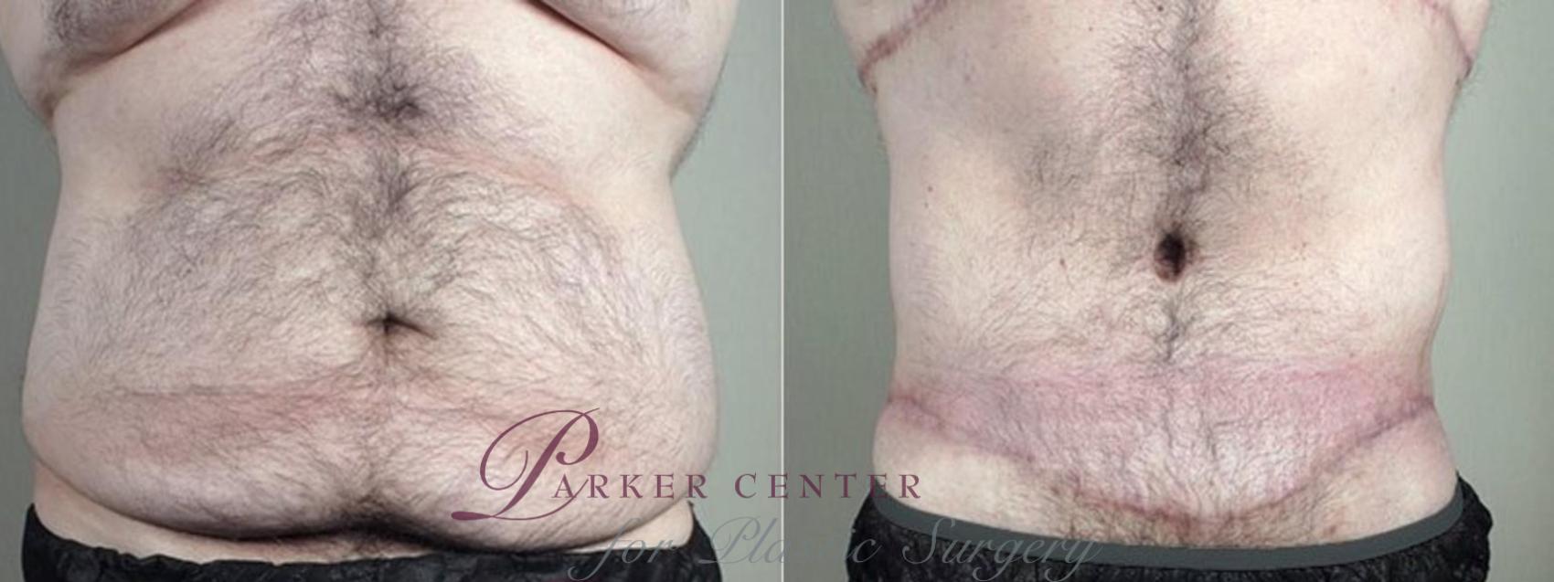 Abdominoplasty Case 1338 Before & After Front | Paramus, NJ | Parker Center for Plastic Surgery