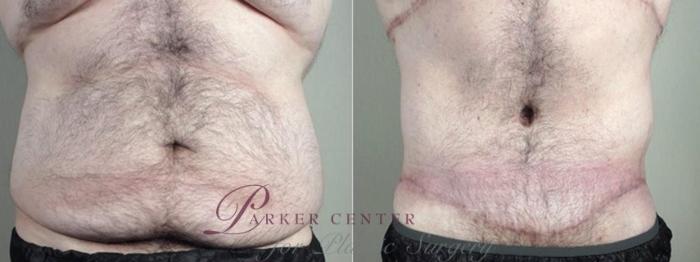 Body Lift Case 1338 Before & After Front | Paramus, NJ | Parker Center for Plastic Surgery