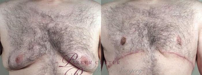 Abdominoplasty Case 1338 Before & After front view 2  | Paramus, NJ | Parker Center for Plastic Surgery