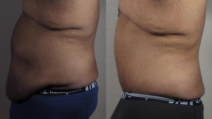 Abdominoplasty Case 1525 Before & After Left Side | Paramus, New Jersey | Parker Center for Plastic Surgery