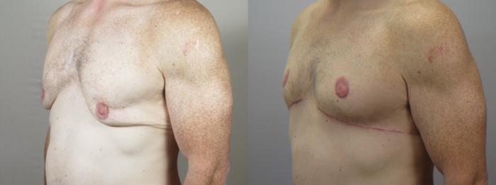 Abdominoplasty Case 1571 Before & After 1 | Paramus, New Jersey | Parker Center for Plastic Surgery