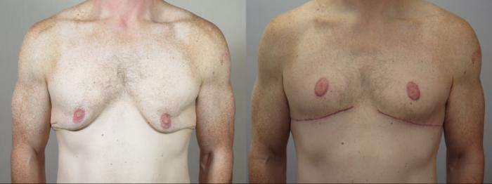 Abdominoplasty Case 1571 Before & After 2 | Paramus, New Jersey | Parker Center for Plastic Surgery