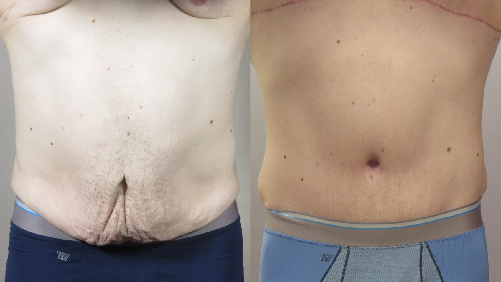 Abdominoplasty Case 1571 Before & After Front | Paramus, New Jersey | Parker Center for Plastic Surgery