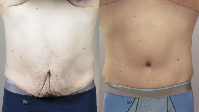Abdominoplasty Case 1571 Before & After Front | Paramus, New Jersey | Parker Center for Plastic Surgery