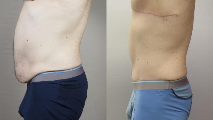 Abdominoplasty Case 1571 Before & After Left Side | Paramus, New Jersey | Parker Center for Plastic Surgery