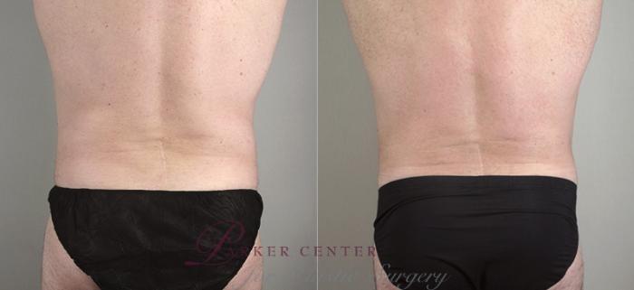 Abdominoplasty Case 641 Before & After View #3 | Paramus, NJ | Parker Center for Plastic Surgery