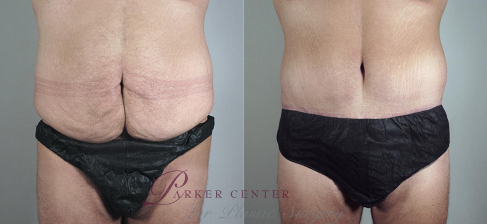 Abdominoplasty Case 681 Before & After View #1 | Paramus, NJ | Parker Center for Plastic Surgery