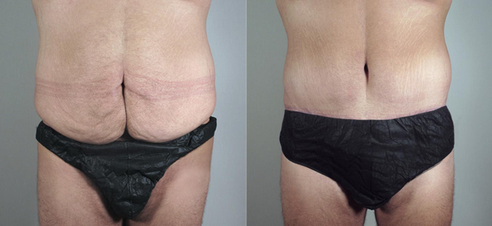 Abdominoplasty Case 681 Before & After View #1 | Paramus, NJ | Parker Center for Plastic Surgery