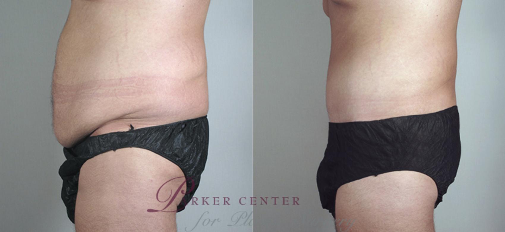 Abdominoplasty Case 681 Before & After View #2 | Paramus, NJ | Parker Center for Plastic Surgery