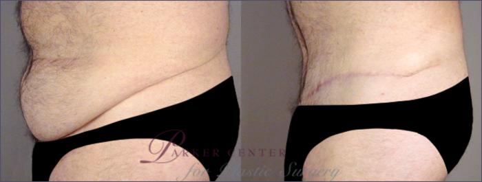 Abdominoplasty Case 682 Before & After View #2 | Paramus, NJ | Parker Center for Plastic Surgery