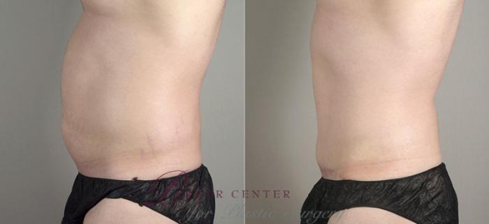 Abdominoplasty Case 713 Before & After View #2 | Paramus, NJ | Parker Center for Plastic Surgery