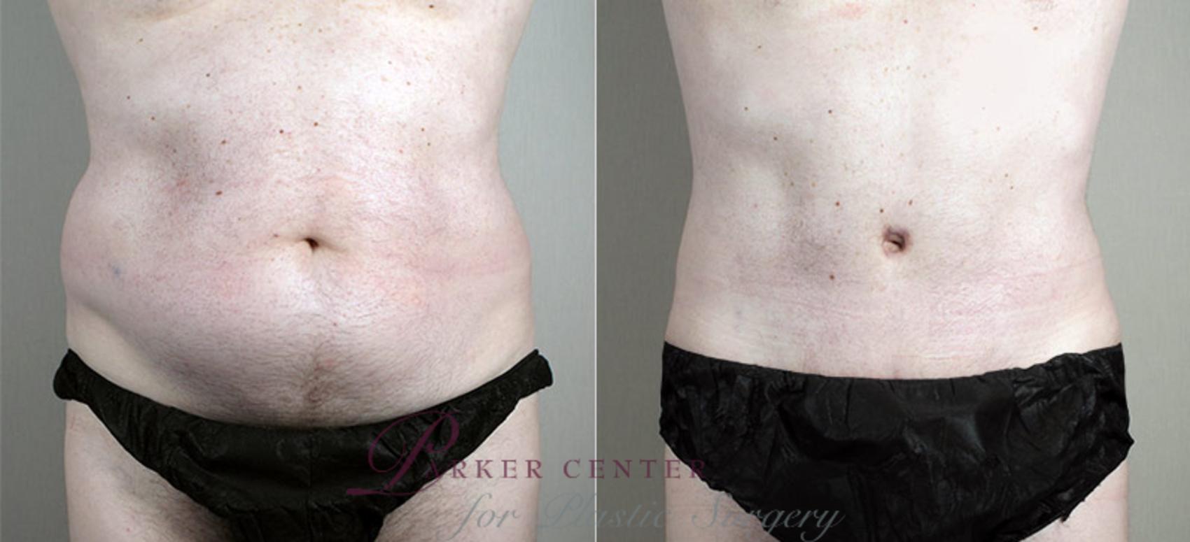 Liposuction Case 725 Before & After View #1 | Paramus, NJ | Parker Center for Plastic Surgery