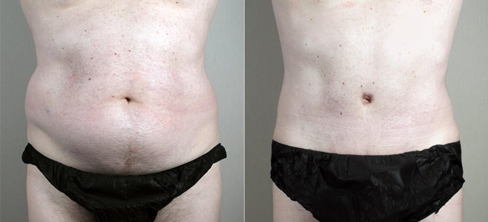 Male Abdominoplasty New Jersey, Tummy Tuck For Men Morristown