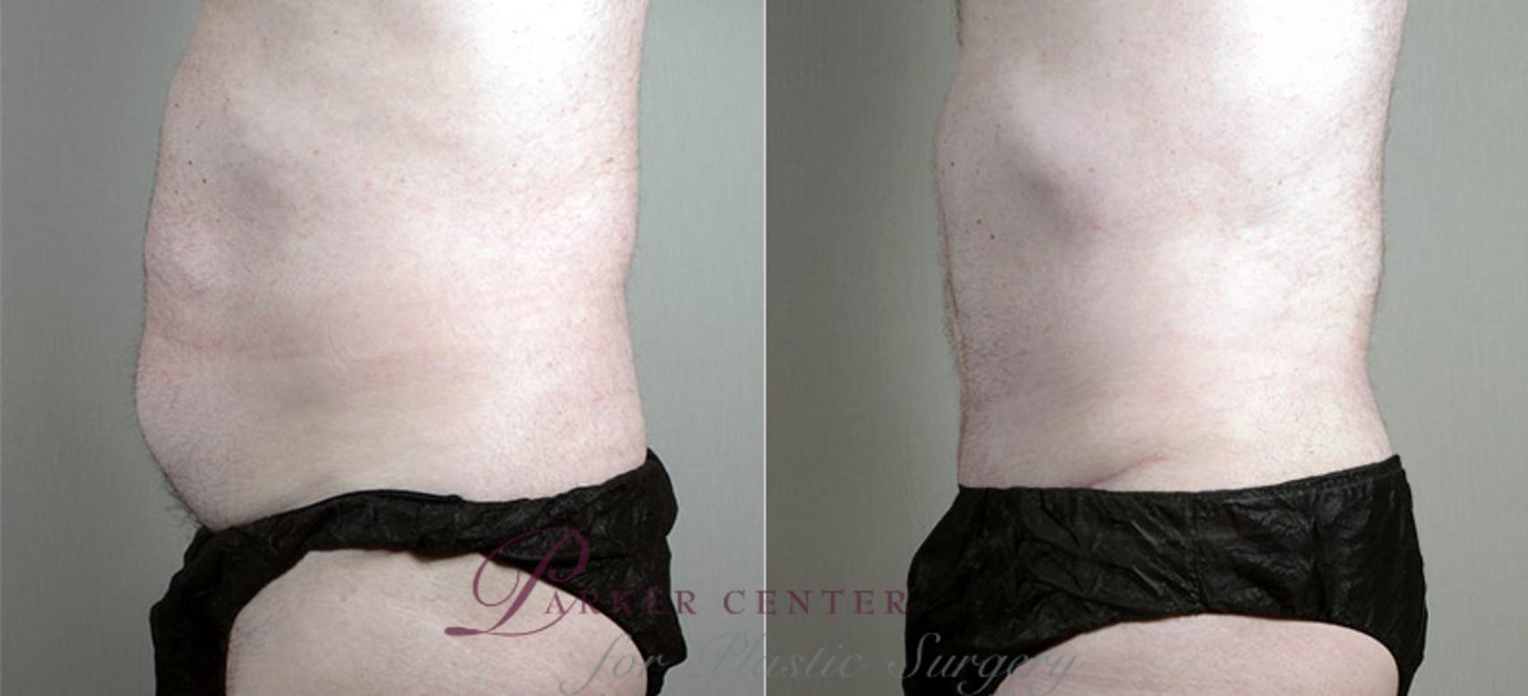 Liposuction Case 725 Before & After View #2 | Paramus, NJ | Parker Center for Plastic Surgery