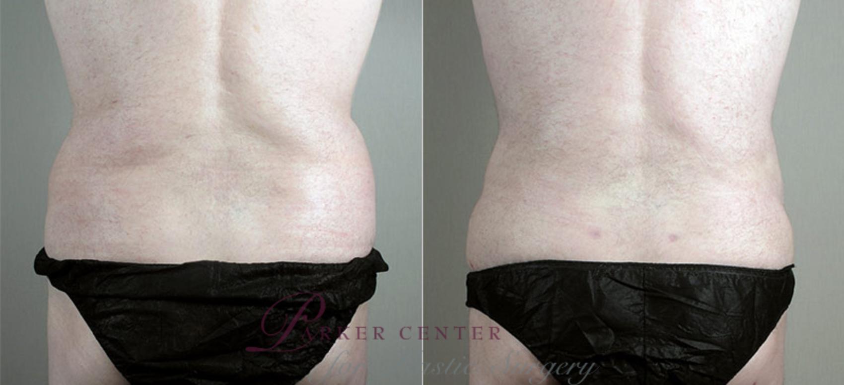 Liposuction Case 725 Before & After View #3 | Paramus, NJ | Parker Center for Plastic Surgery
