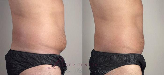Abdominoplasty Case 736 Before & After View #2 | Paramus, NJ | Parker Center for Plastic Surgery