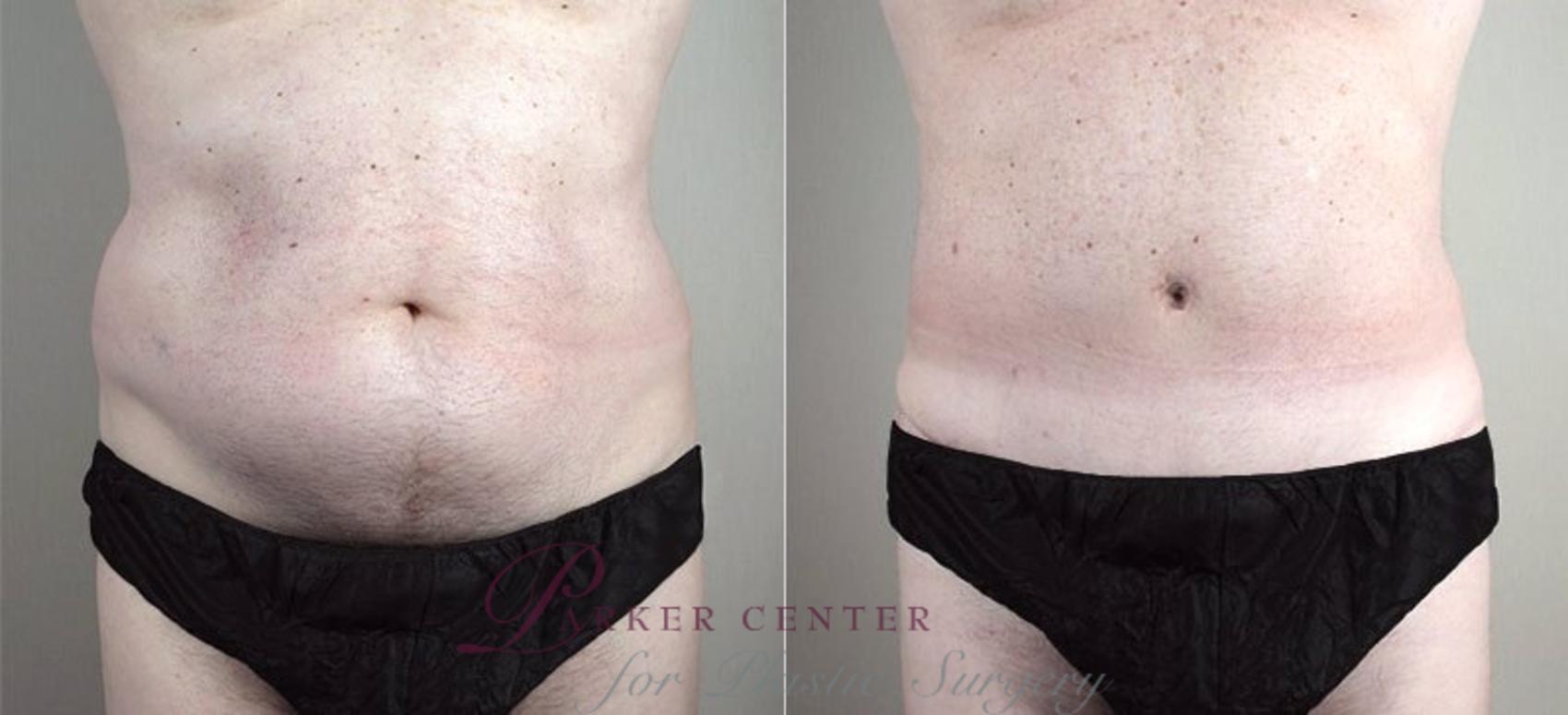 Abdominoplasty Case 738 Before & After View #1 | Paramus, NJ | Parker Center for Plastic Surgery