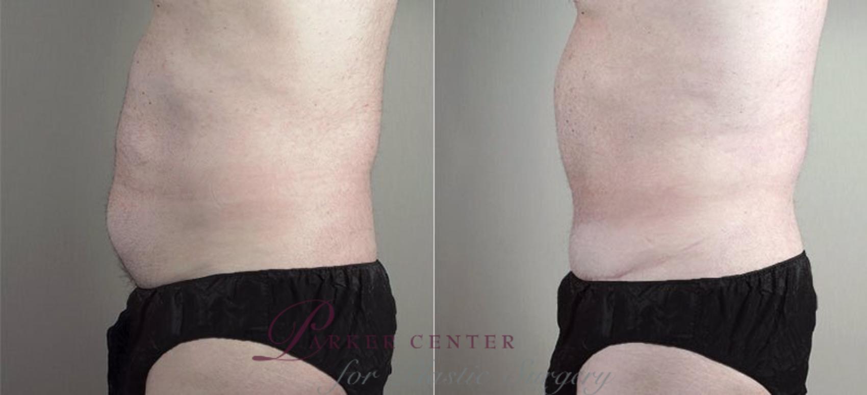 Abdominoplasty Case 738 Before & After View #2 | Paramus, NJ | Parker Center for Plastic Surgery