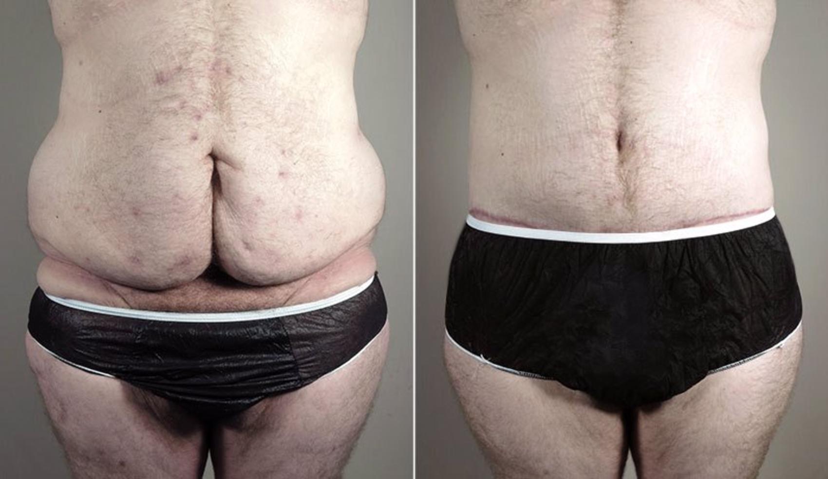 Patient before (left) and after (right) a male-pattern upper body lift.