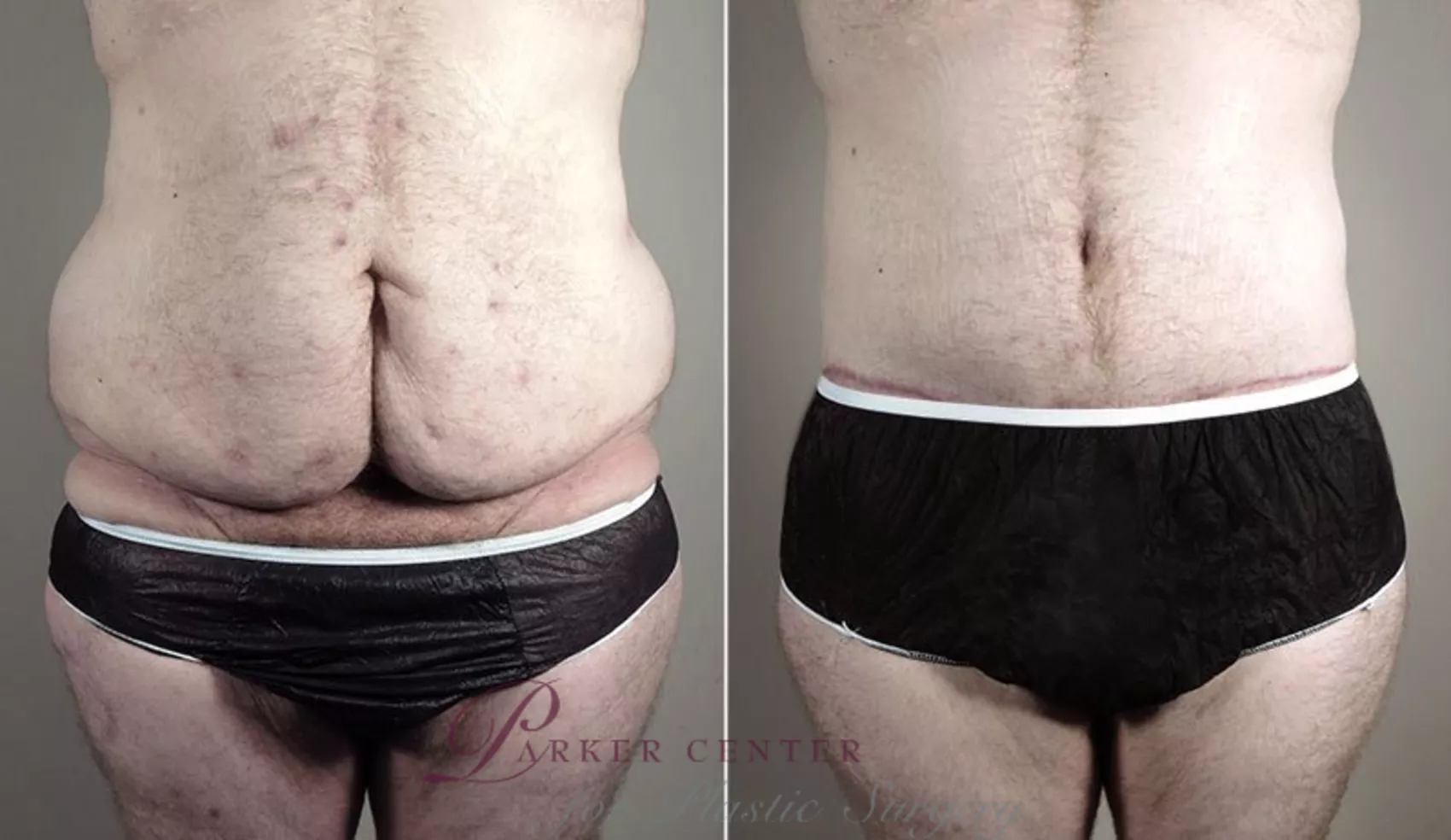 Abdominoplasty Before and After Pictures Case 743, Paramus, NJ