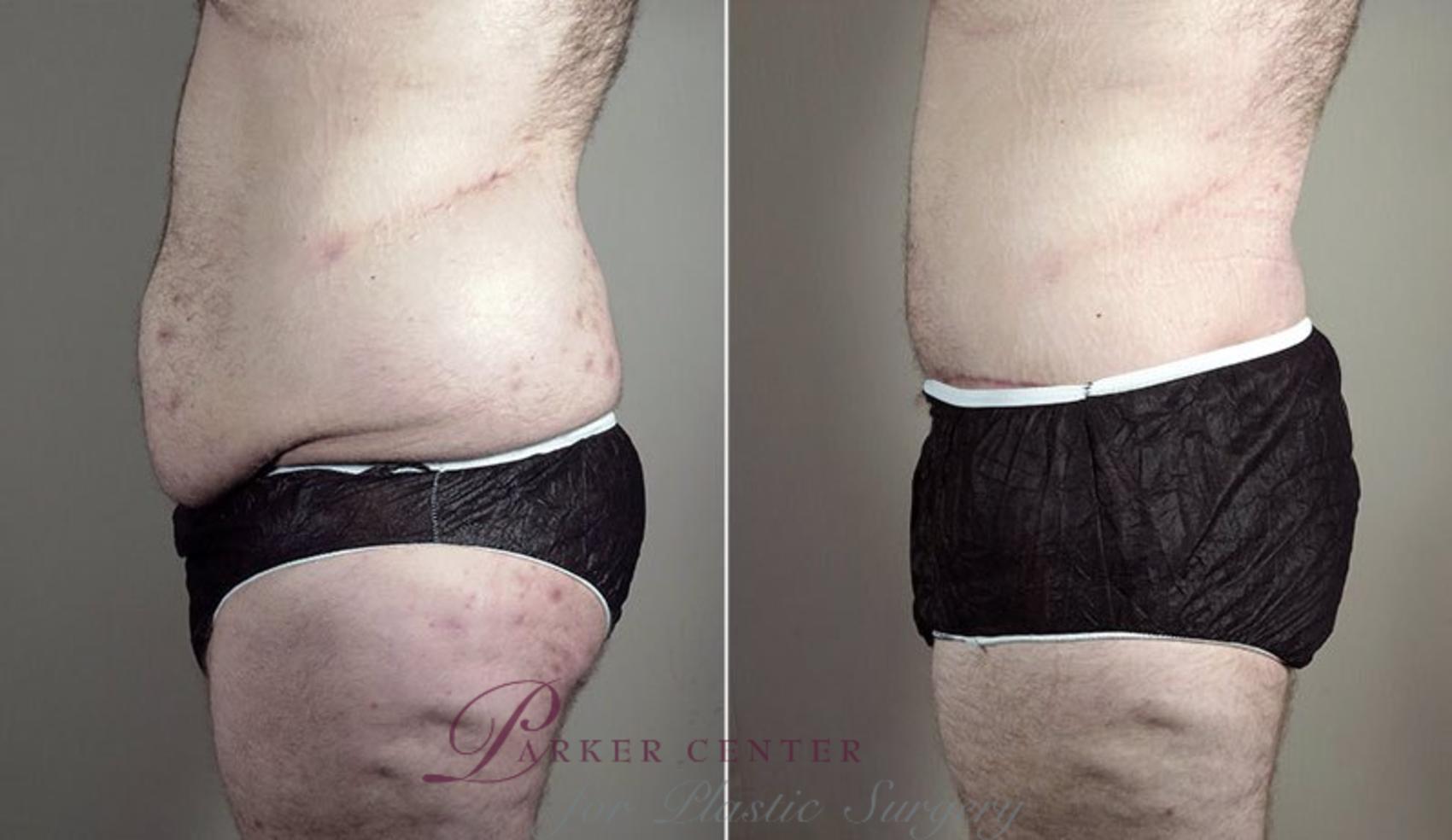 Abdominoplasty Case 743 Before & After View #2 | Paramus, NJ | Parker Center for Plastic Surgery